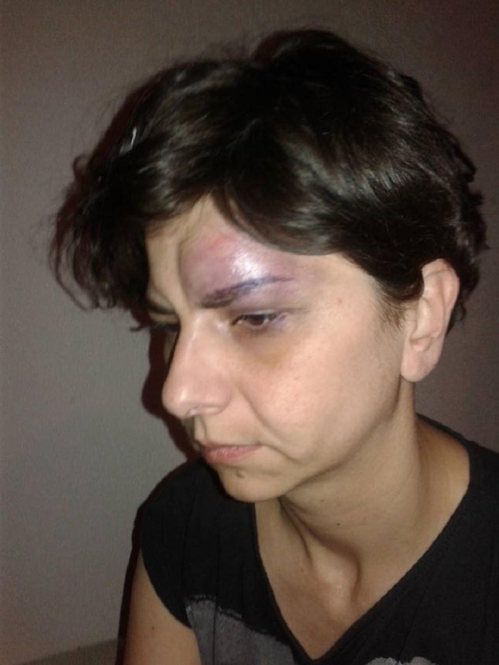 Partner ju je pretukao, policija mu ne može ništa (FOTO)