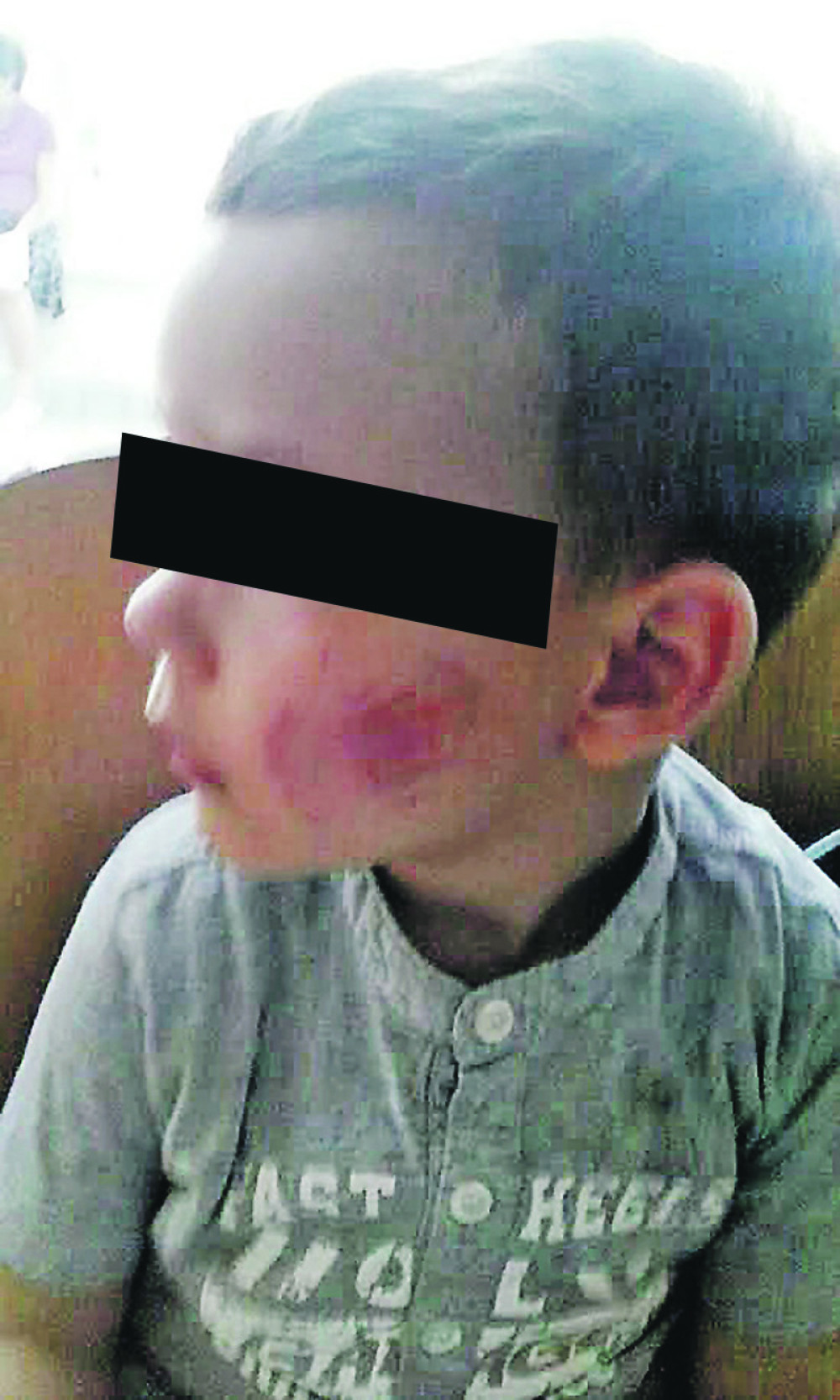 Dečak izujedao druga (3) u vrtiću! (FOTO)