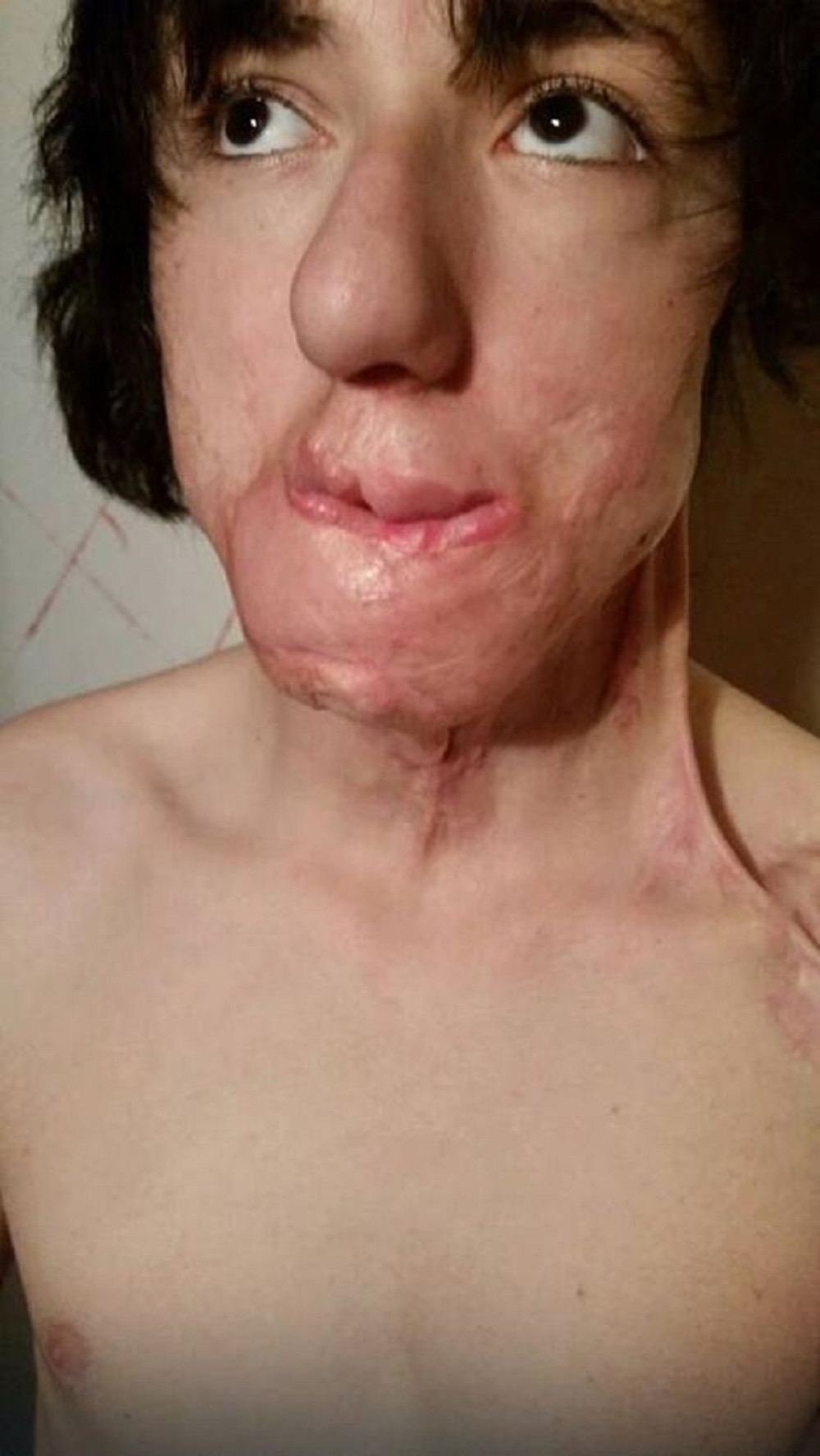 Milošu je kao bebi otkriven tumor, treba mu naša pomoć!