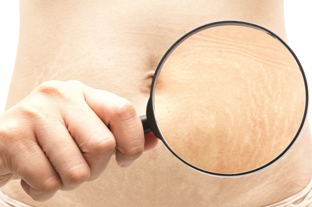 Uklonite strije sa tela u 4 jednostavna koraka! (RECEPT)