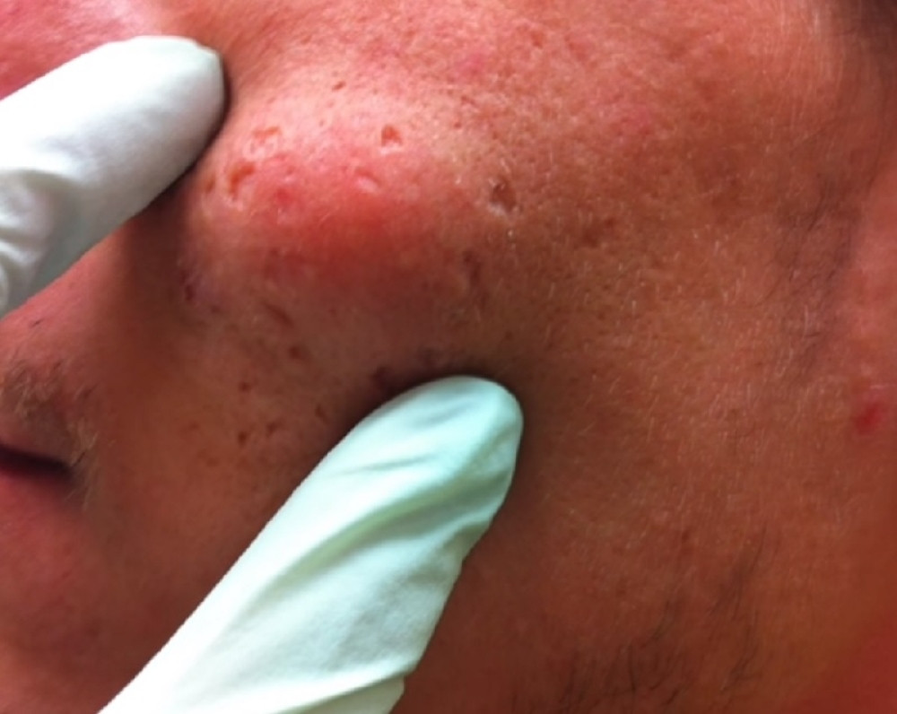 Zbog bubuljice morao na operaciju, a onda je iz nje počelo da pršti! (UZNEMIRUJUĆI VIDEO)