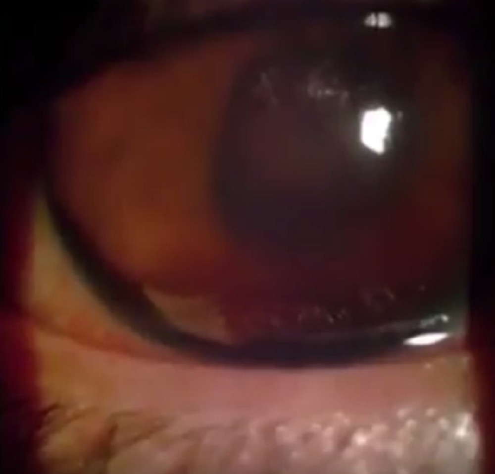 Žalio se na nepodnošljive bolove u oku, lekari mu pronašli ovo (VIDEO)