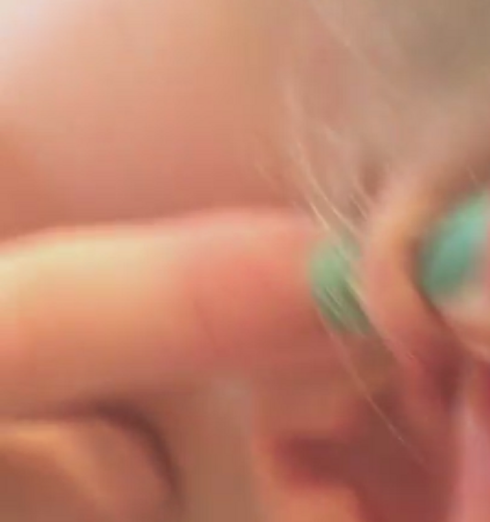 Ovo je najduže i najodvratnije ceđenje bubuljice ikada! (VIDEO)