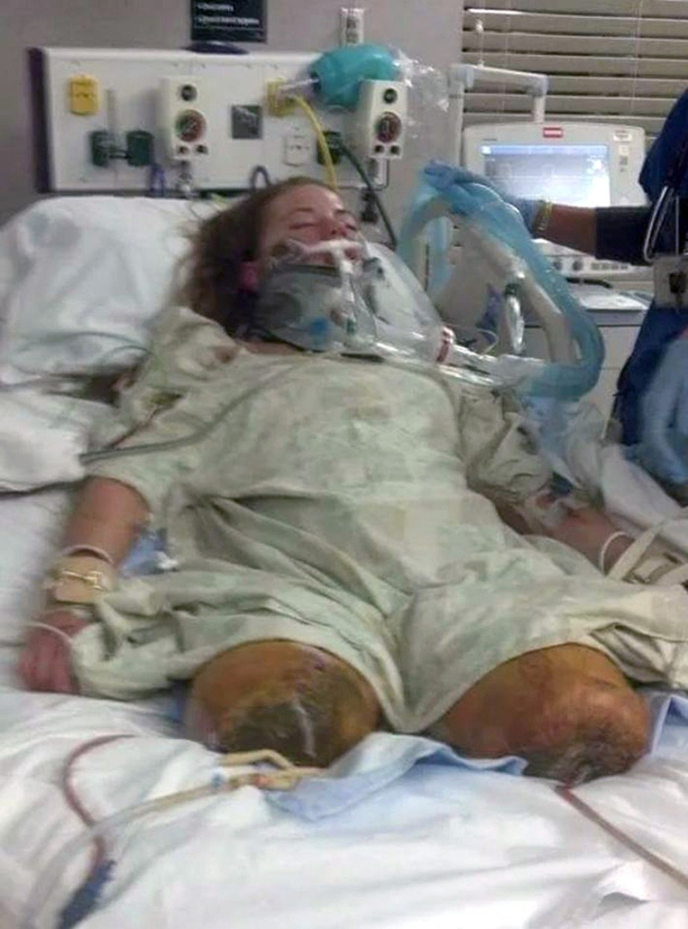 Izašla iz paba da zapali cigaretu, probudila se u bolnici bez nogu! (UZNEMIRUJUĆI FOTO)