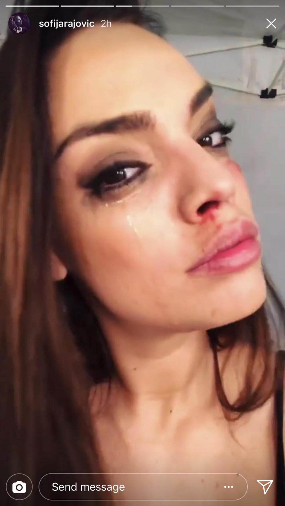 Srpska glumica sva u modricama i podlivima! (FOTO)