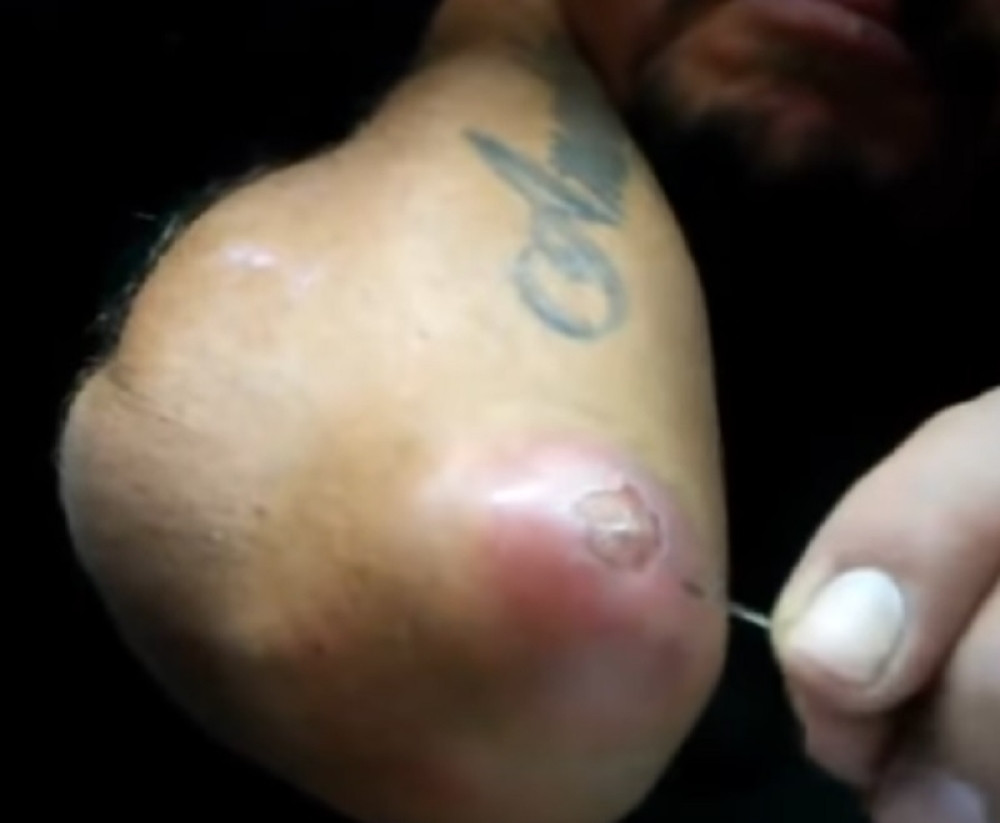 Probušio bubuljicu na laktu, svima je zgadio život (VIDEO)