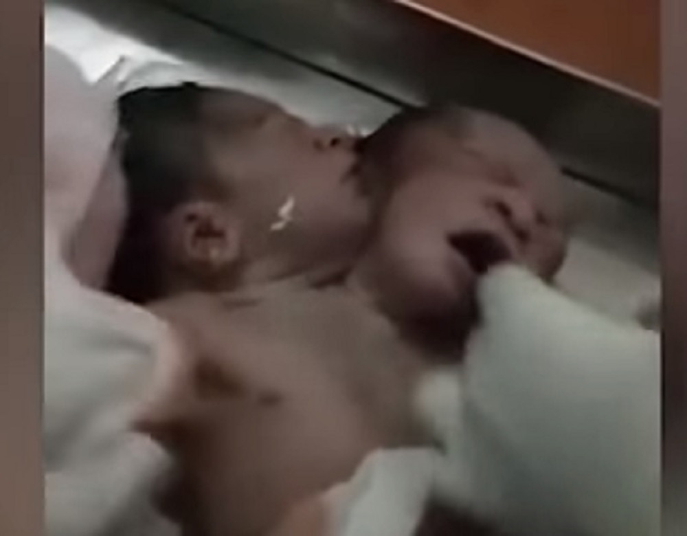 Rođena beba sa dve glave