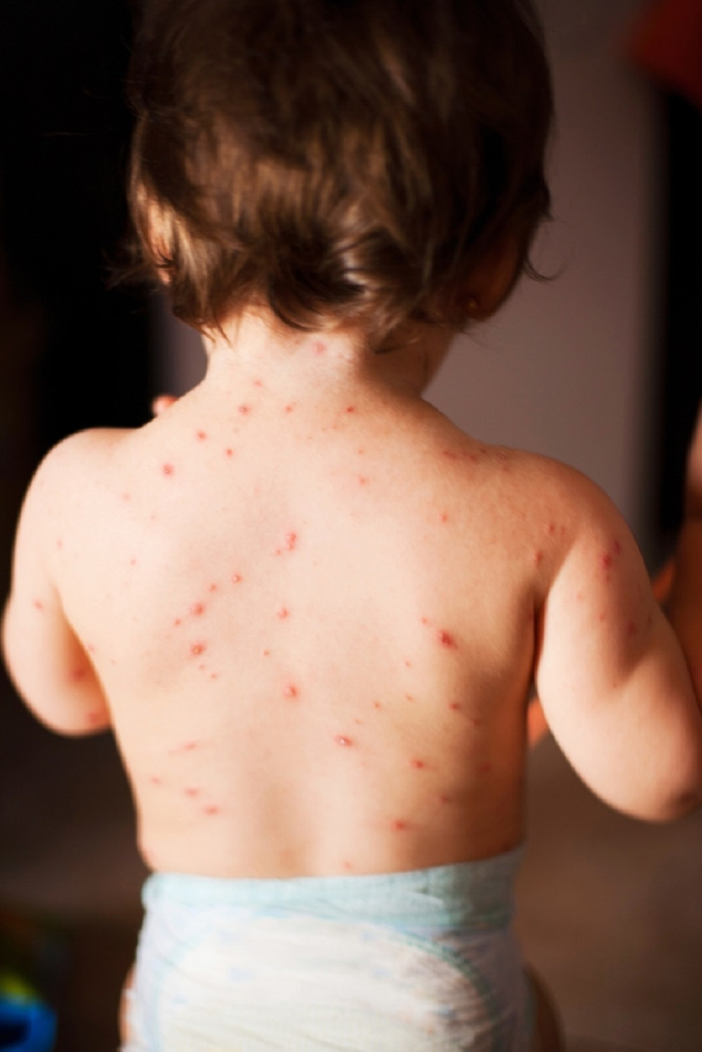 U Srbiji registrovano 1.327 slučajeva malih boginja