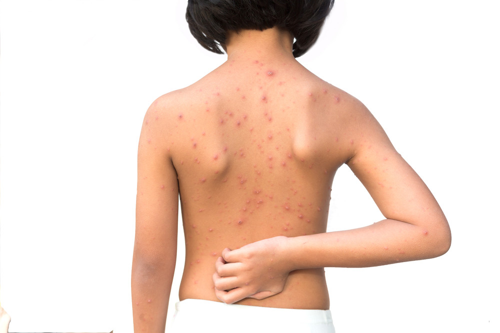 U Despotovcu porodica dobila boginje