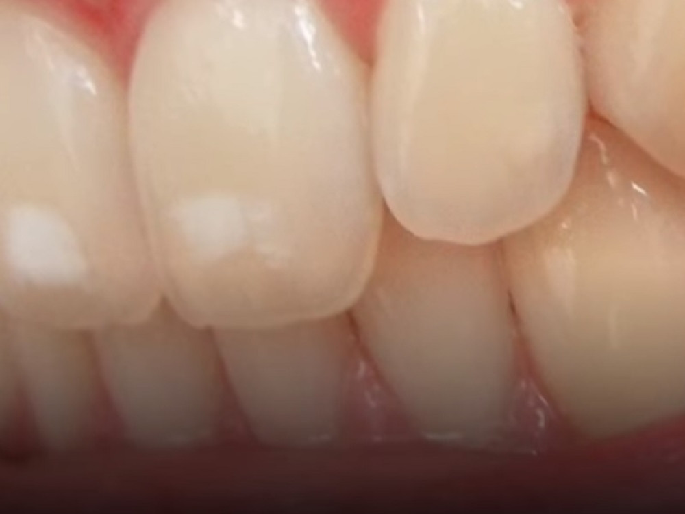 Imate probleme sa osetljivim zubima? Evo kako da ih rešite