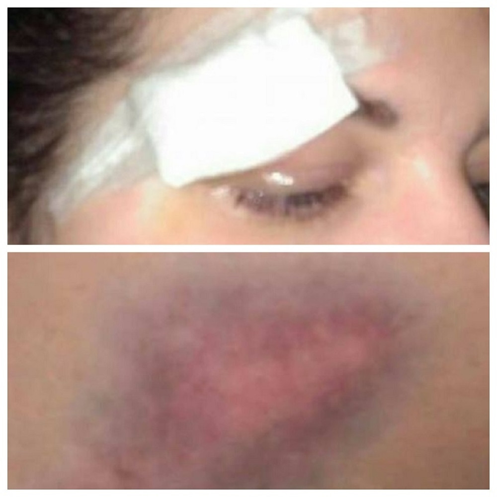 Bivšu učesnicu "Farme" pretukao dečko!