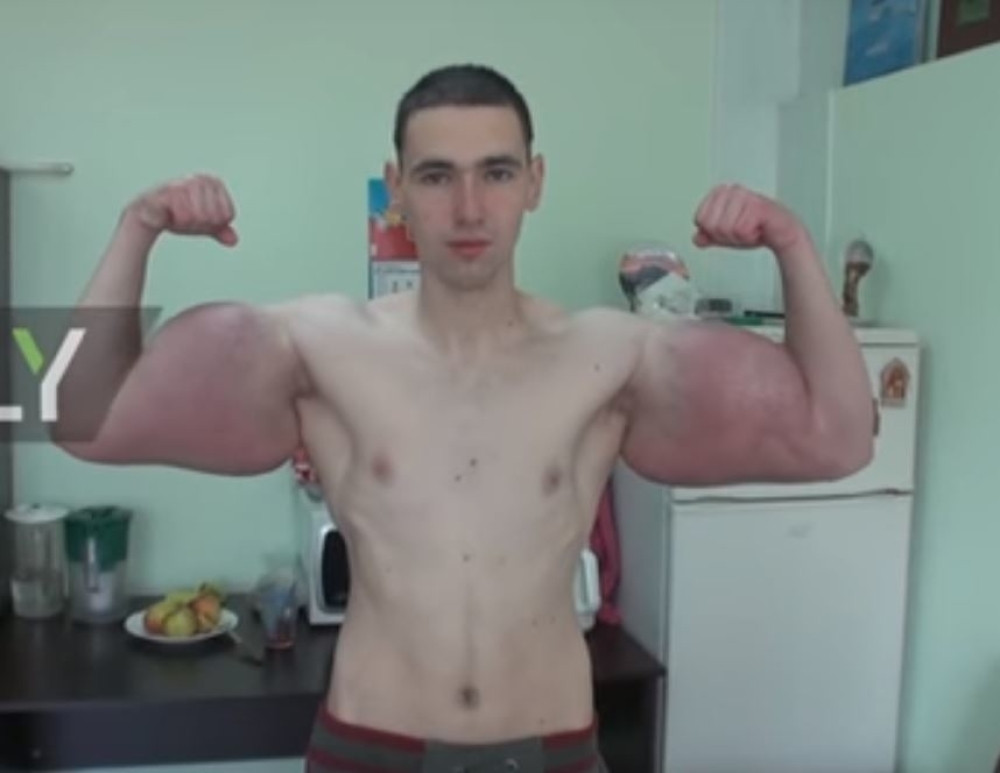 Ima najveće bicepse, ali amputiraće mu ruke