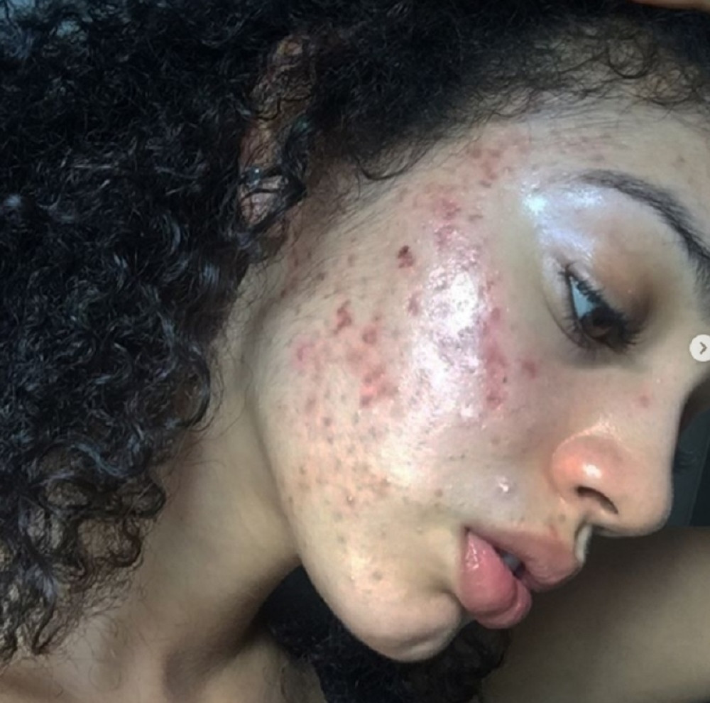 Ova devojka ima prirodan recept za lečenje akni!