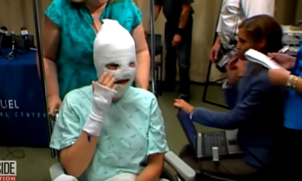 Zadobila je opekotine po licu i glavi, psiholozi šokirani