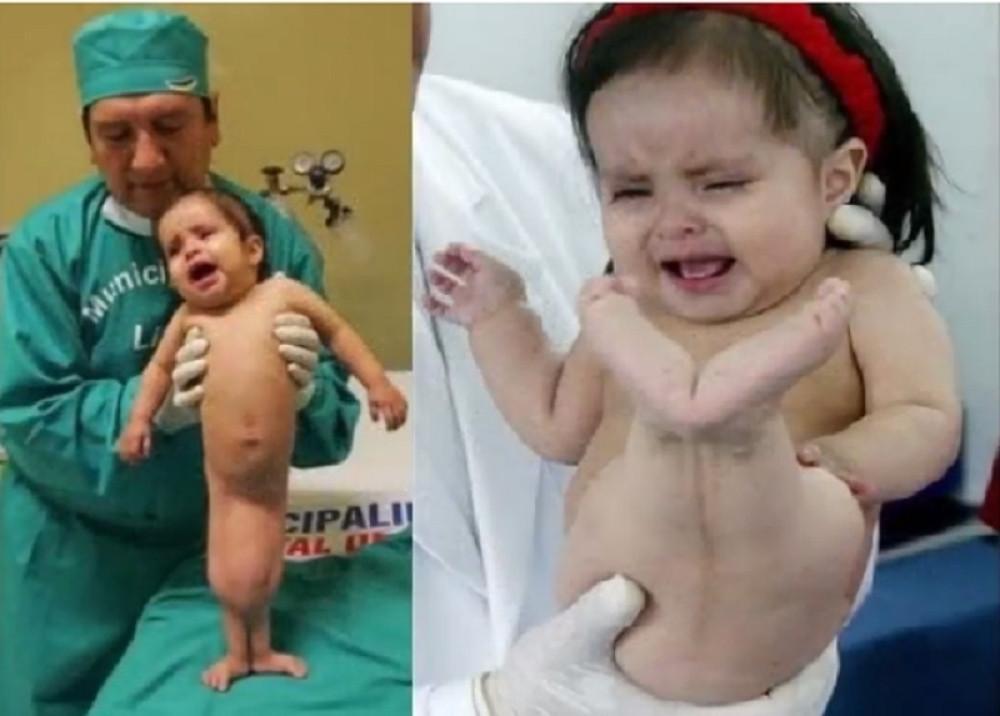 Rođena je kao sirena, pogledajte kako danas izgleda ova čudesna devojčica