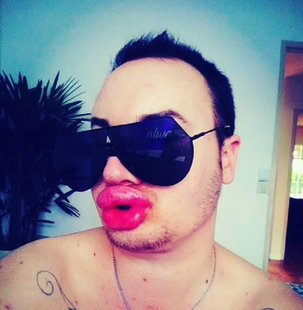 Imao 20 operacija kako bi ličio na Merilin Monro, šok tek sledi!