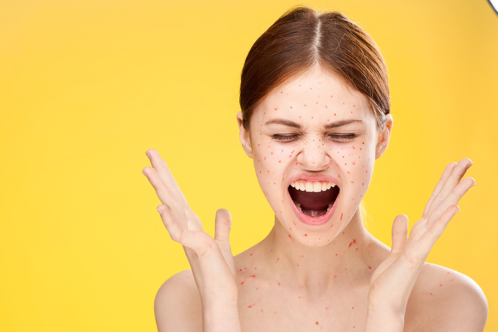 Stručnjaci tvrde da su ovi prirodni lekovi najbolji u otklanjanju bubuljica!