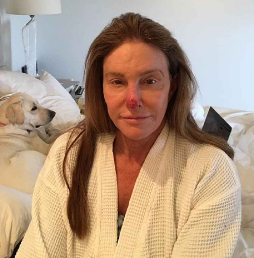 Kejtlin Džener objavila uznemirujuću fotku, boji se da ne ostane bez nosa!