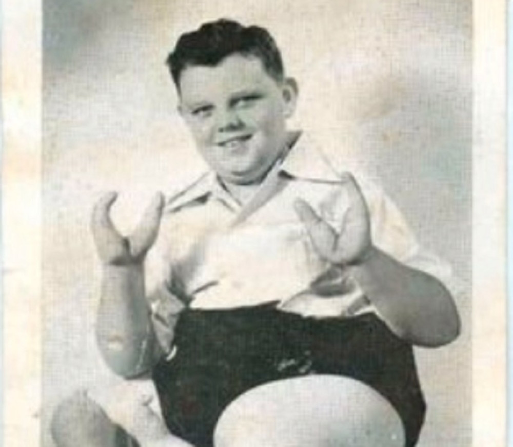 Dečak "Jastog" je svojim kleštima davio decu u cirkusu, a onda ga je njegova porodica ubila!