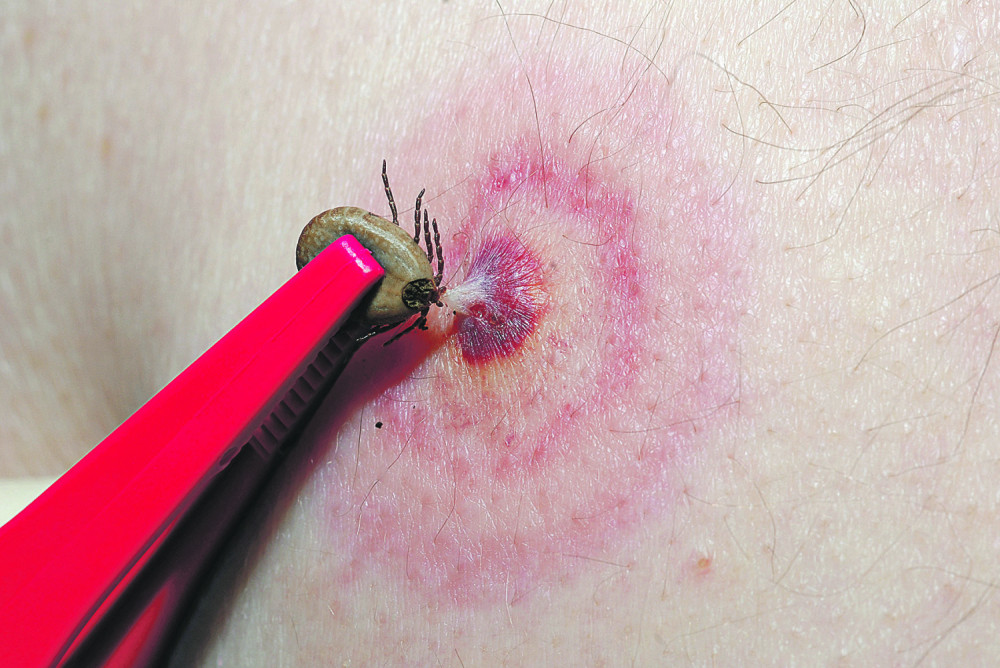 Pustili krpelje da zarze 300.000 ljudi, a onda pručavali njihovo lečenje i smrt!