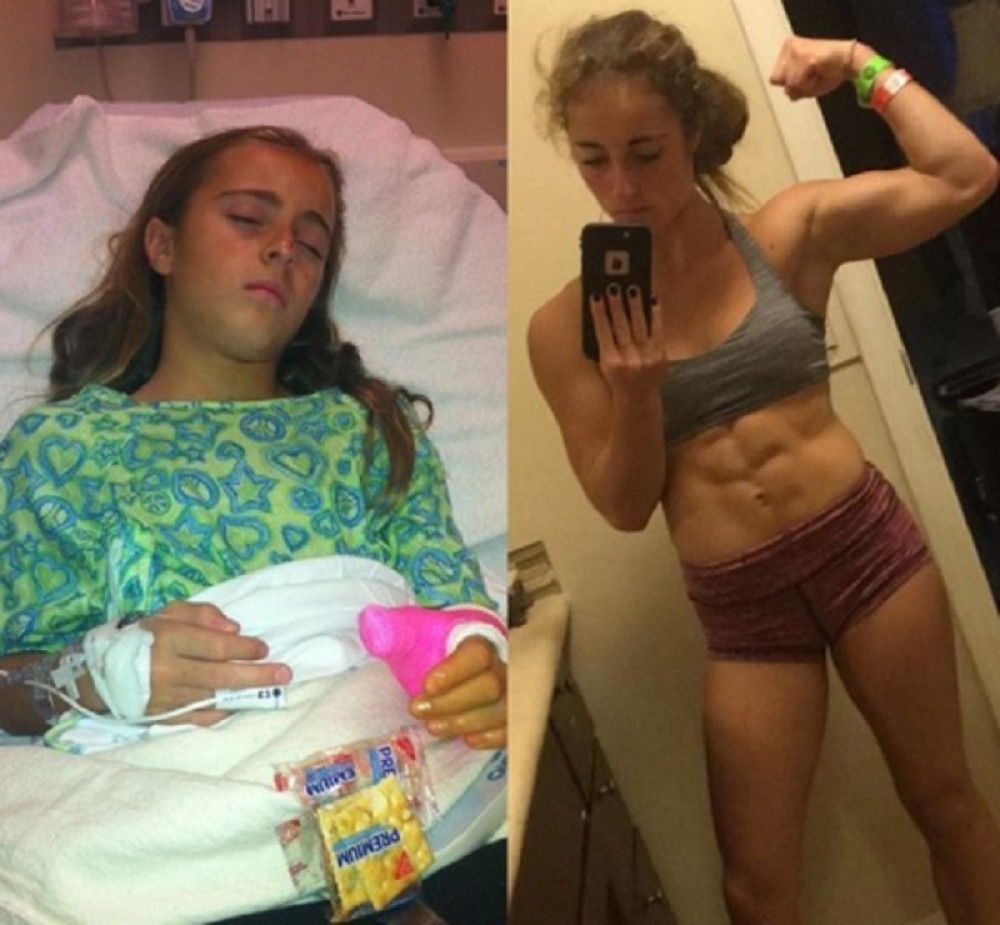 Slomila kičmu, a kada se oporavila počela da radi neverovatne stvari!