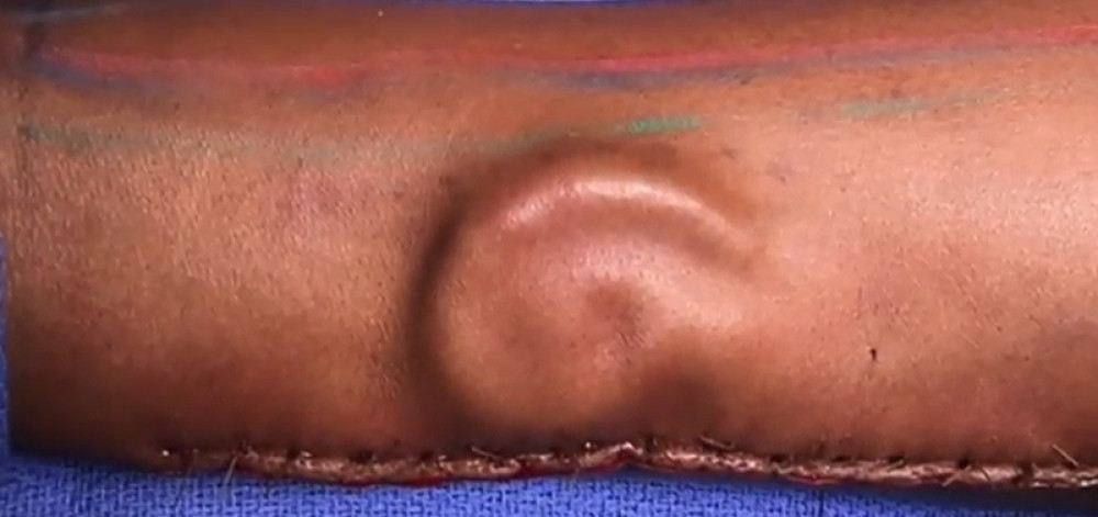 Devojka u nesreći izgubila uvo, a onda su lekari učinili nešto neverovatno!