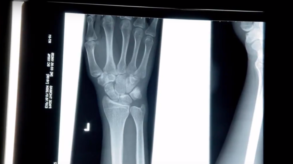 Veštačka inteligencija detektuje i najsitnije prelome kostiju