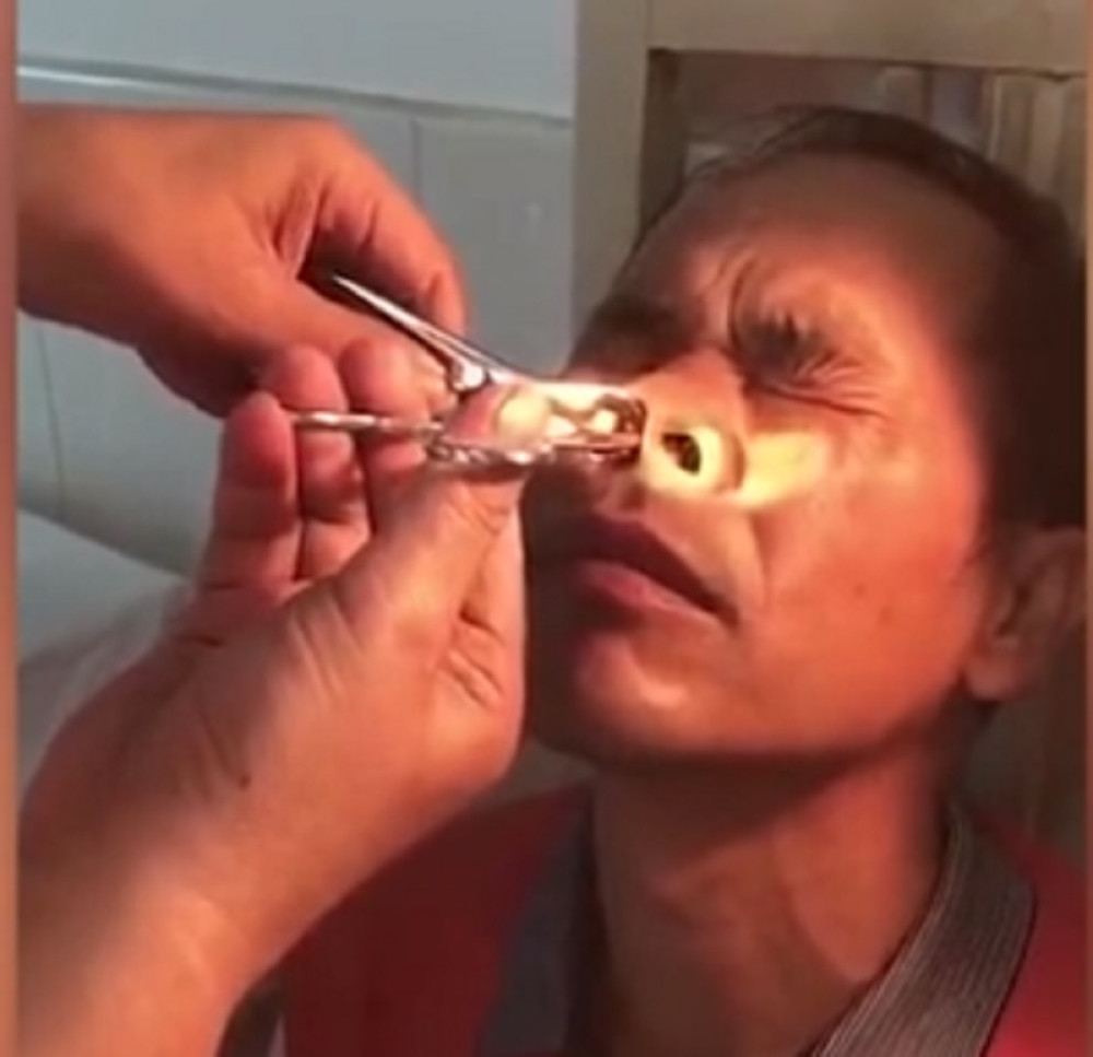 ZGADIĆE VAM SE ŽIVOT kada vidite šta je lekar izvukao ovom pacijentu iz NOSA!