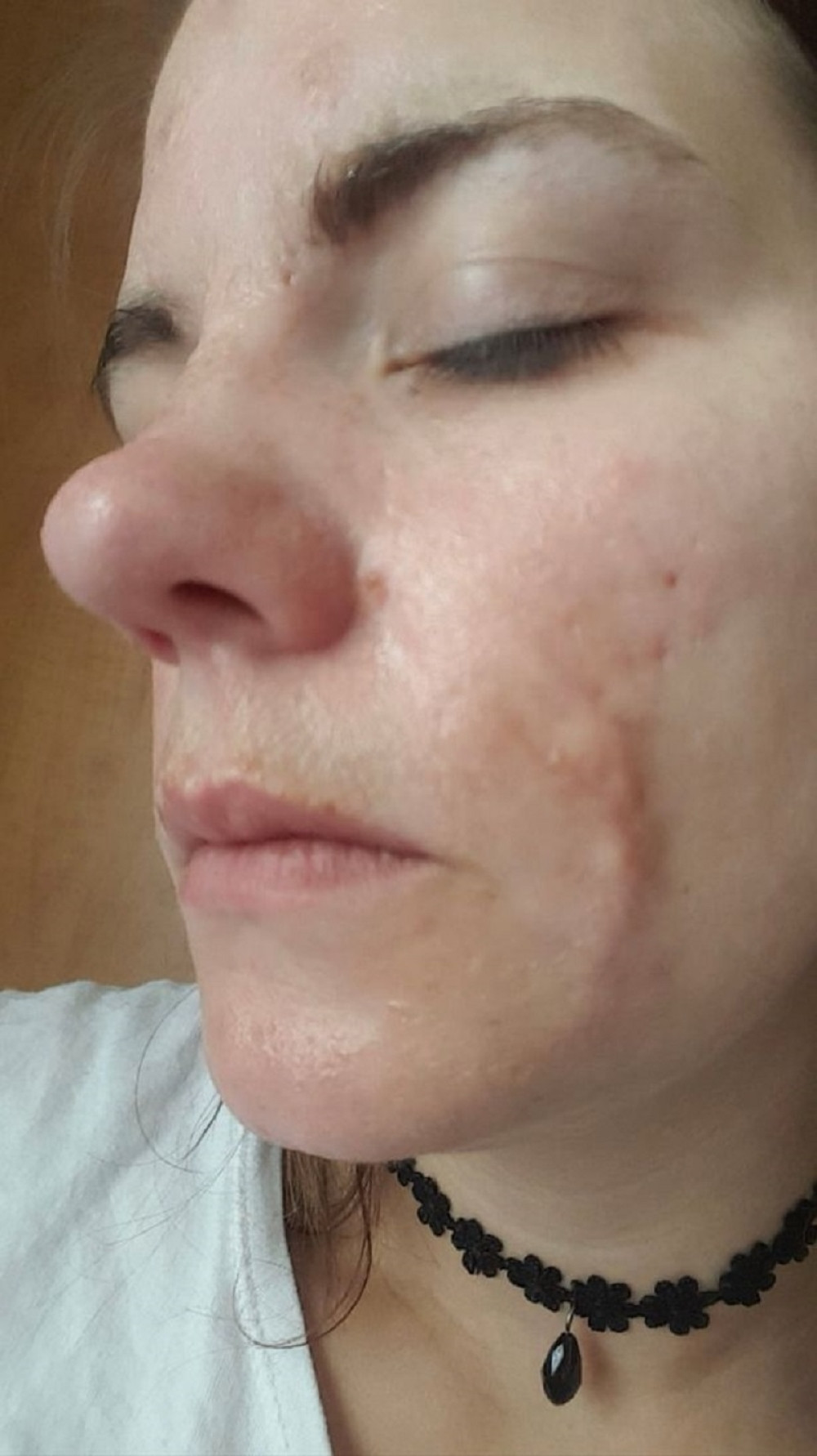 Lice joj je toliko gorelo od akni, da je iskoristila mleko kojim je dojila dete i učinila nešto ODVRATNO