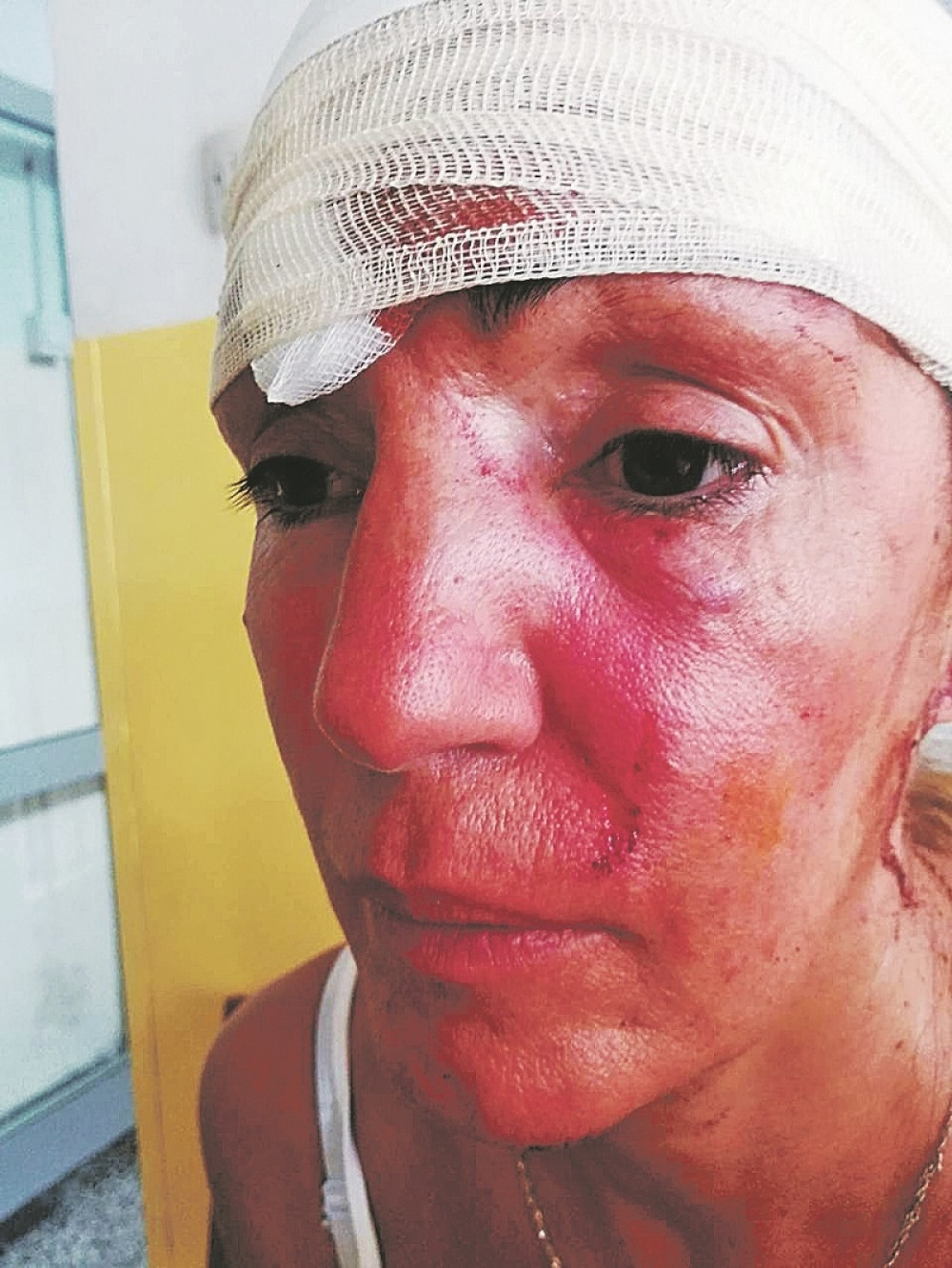 Beograđanka Vesna otišla na Adu Ciganliju da se sunča, a završila sa kopčama na čelu i modricama