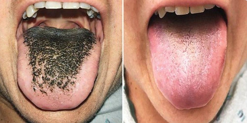 Žena je pila antibiotike, a onda je ugledala stravične crne dlake koje joj izviruju iz jezika!