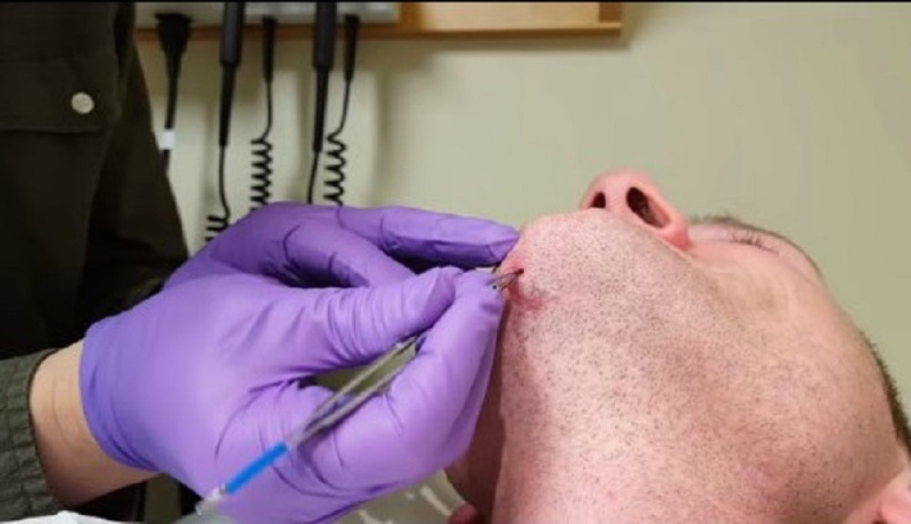 Na bradi je video uraslu dlaku. Kad su krenuli da mu je vade ostali su u šoku zbog njene veličine (VIDEO)