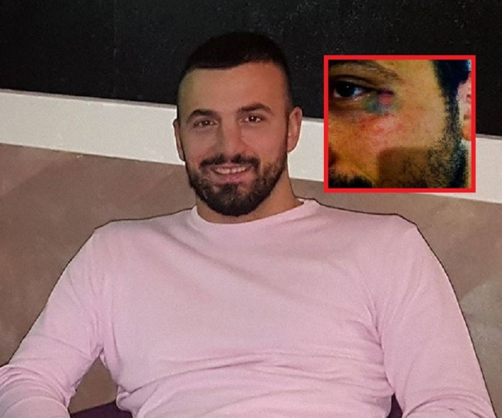 ŠOK FOTKA, PODLIVI I MODRICE: Ovo je istina o batinama! Evo šta se desilo sa Vladimirom! (FOTO)