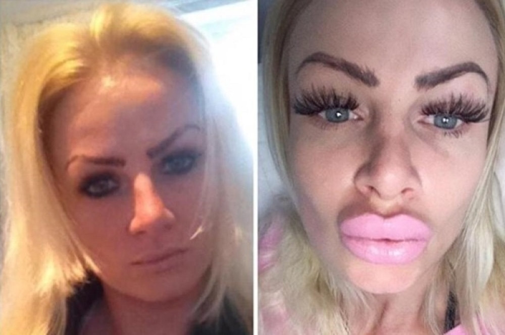 Godinama su izgledale kao SIROVO MESO, a kada je saznala šta su joj ubrizgali ZGADIO JOJ SE ŽIVOT (FOTO)