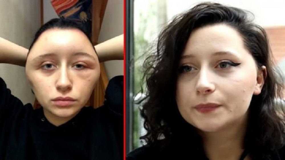 Ofarbala je kosu, a onda joj je glava preko noći TRODUPLO PORASLA i potpuno se deformisala! (VIDEO)