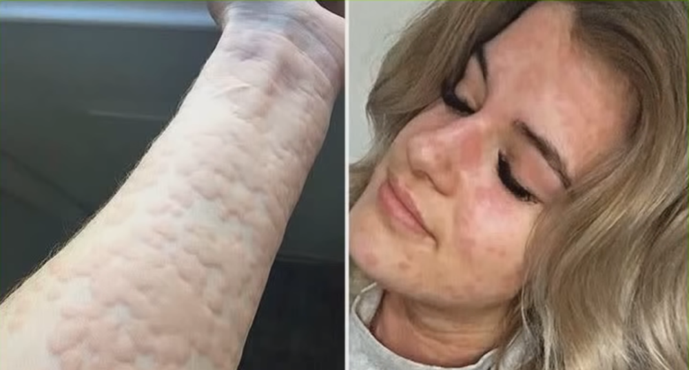 Zbog retkog poremećaja zimi bukvalno NE SME DA IZAĐE IZ KUĆE, a svi joj se smeju!