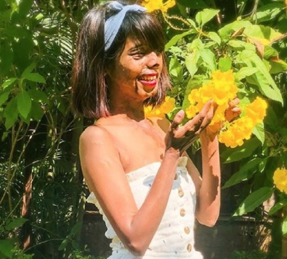 Dok je kao beba bila u maminom naručju, otac ju je polio kiselinom jer je želeo sina! Sada ima motivacionu poruku ČVRSTU KAO STENA!