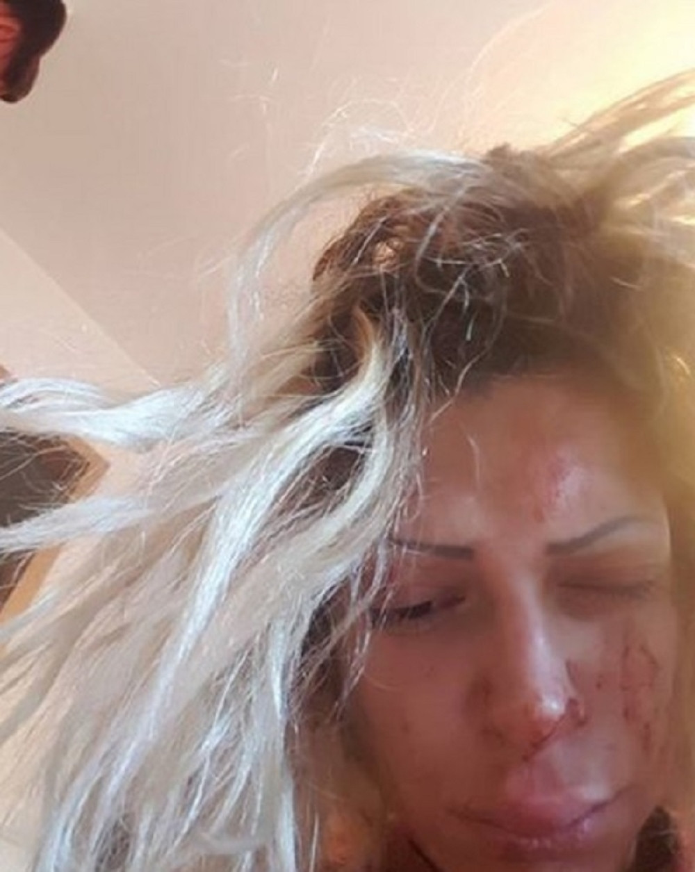 Naša pevačica na lečenju od alkohola! Pila po bocu viskija dnevno a danas izgleda NEPREPOZNATLJIVO! (FOTO)