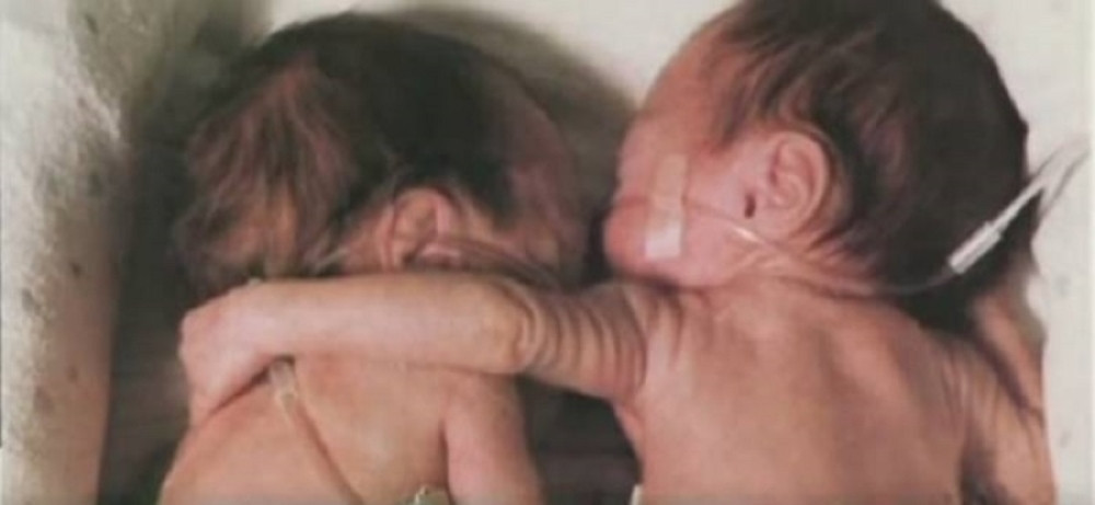 Prevremeno rođena beba zagrlila bliznakinju na samrti: Ono što se desilo nakon toga će vas ostaviti bez reči