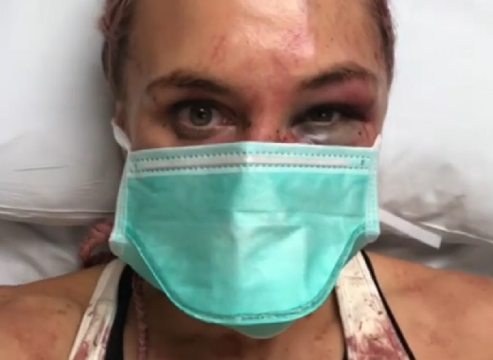 Šta, SMEŠNO TI JE OVO? Ruska fajterka objavila šokantne slike PRE I POSLE meča! (VIDEO)