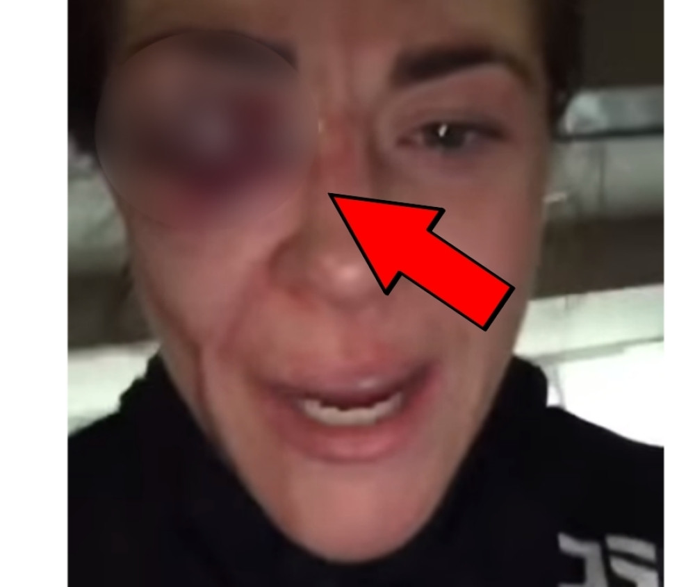 Ovo je jedna od najstravičnijih povreda u sportu! Britanka krvoprolićem UŠLA U ISTORIJU (VIDEO)