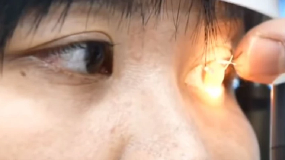Osetila je da joj je nešto upalo u oko, i otišla kod lekara, a ono što su joj otkrili će vas ZGROZITI (VIDEO)