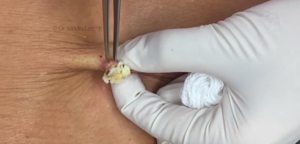 Na leđima joj je nešto raslo. Kada je lekarka TO otvorila imala je ŠTA da vidi