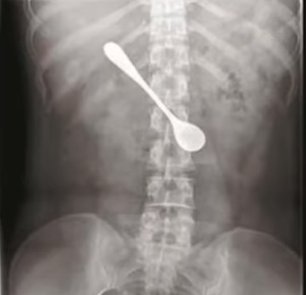 Pokušala da izvadi riblju kost iz grla, pa progutala KAŠIKU, ali problemi su nastali kada je shvatila KOJI JE DATUM!