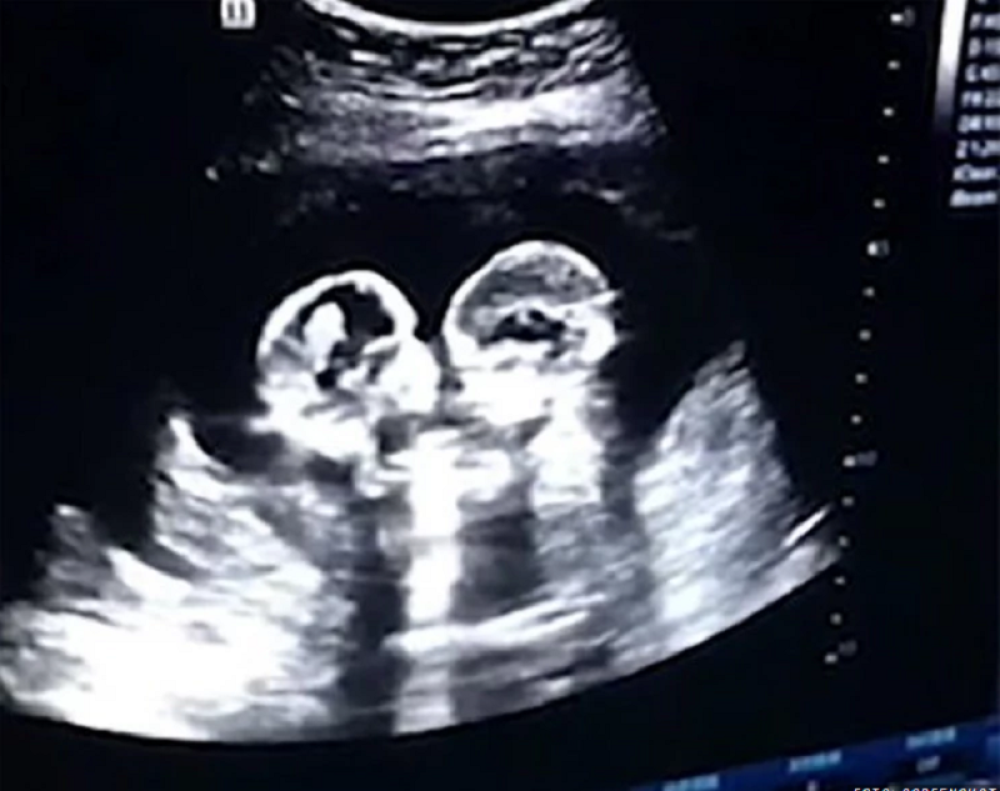 Dve nerođene bliznakinje napravile haos u materici, zbog ovog snimka su postale zvezde iako se JOŠ NISU RODILE!