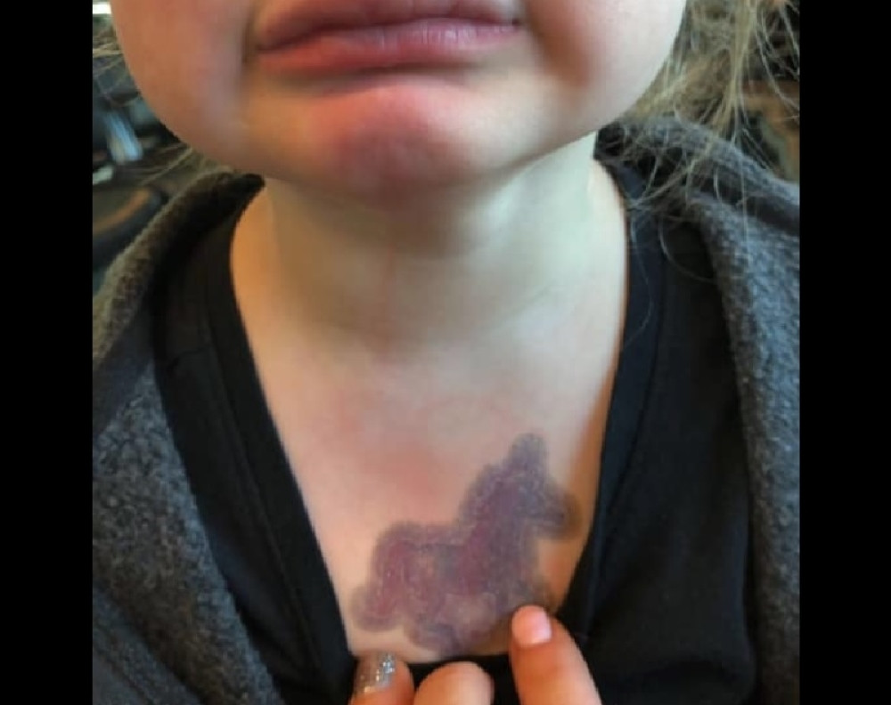 Majka tražila vodu za ćerku, posle prvog gutljaja dete (4) vrištalo od bola! Rane u ustima, na grudima... (FOTO)