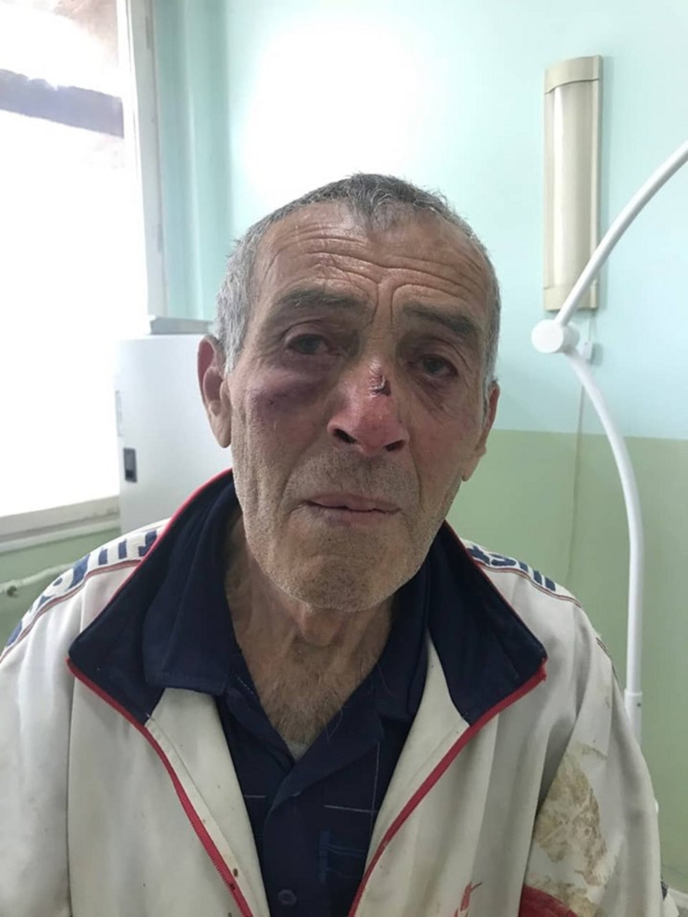 Ovo je GLUVONEMI SRBIN kog su šiptarski monstrumi danas brutalno pretukli! UNIŠTILI lice čoveku! (UZNEMIRUJUĆI FOTO)