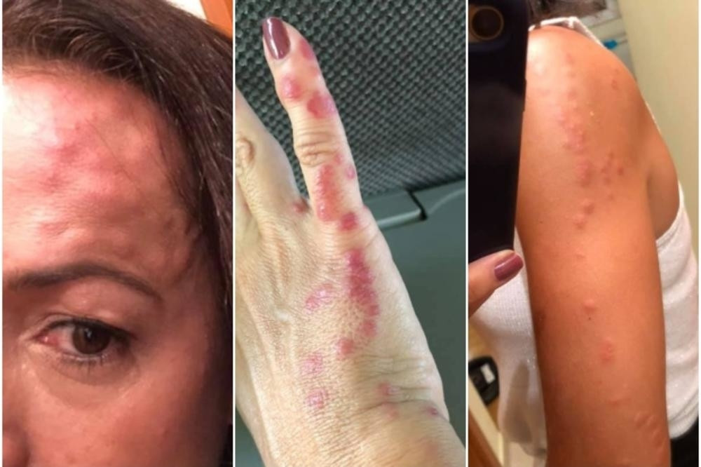 "Imala sam crveno na licu, mislila sam da je od komarca, ali onda je sve počelo DA GORI! Nisam znala da ove BUBE JOŠ POSTOJE!" (FOTO)
