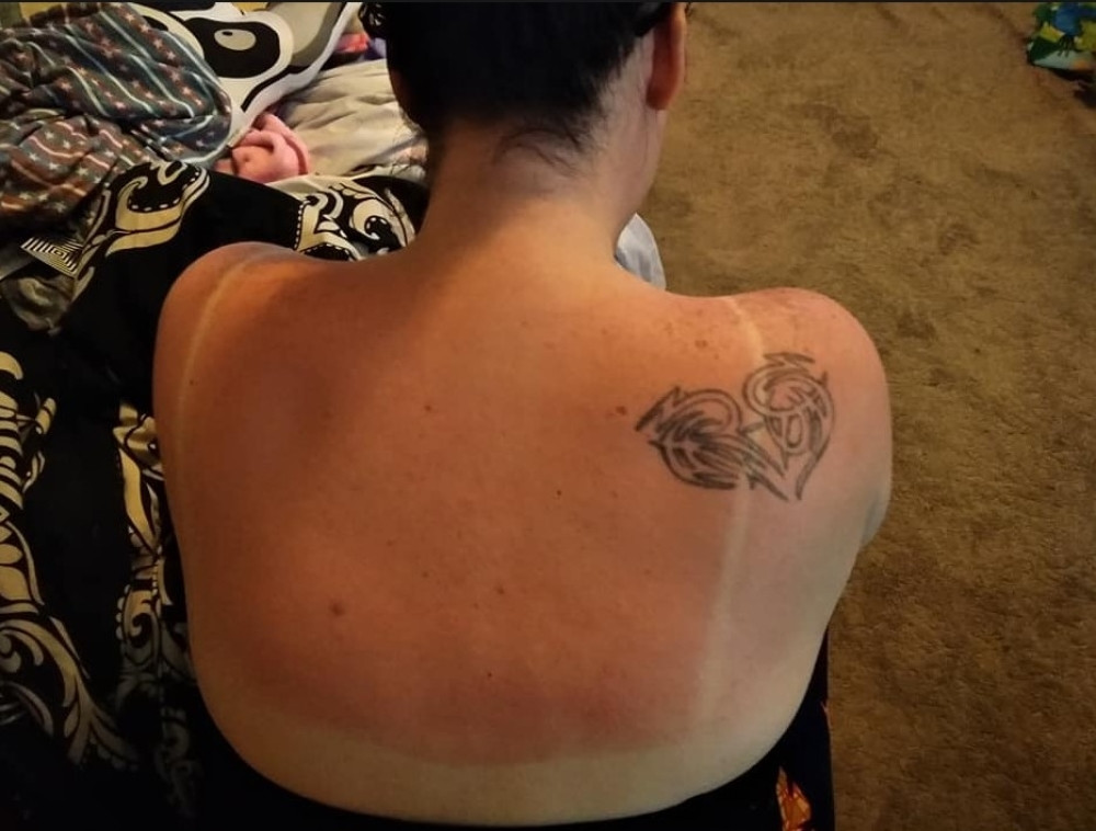 Zaspala je na plaži i IZGORELA! U kupatilu je pronašla ovaj sprej, namazala ga i posle POLA SATA dogodilo se ČUDO! (FOTO)