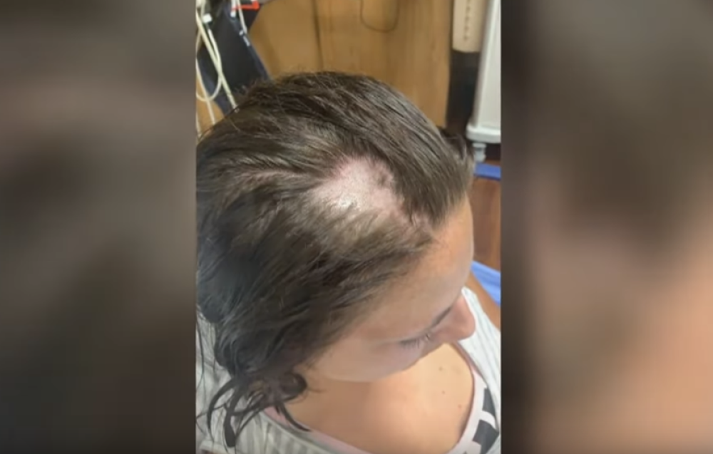 Ako vam opada kosa, evo kako da se lečite!